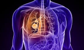 Lung Cancer Treatment Cost in India: An Overview