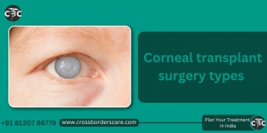 Breaking Down Corneal Transplant Costs in India: What to Expect