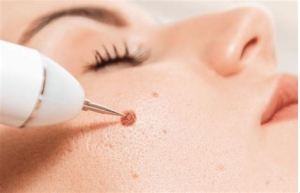 A Complete Guide to Having Moles Removed Painless