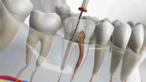 The Importance of Root Canal Treatment: Expert Insights for Patients in Lahore