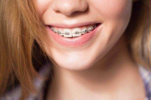 Why Metal Braces Are the Best Choice for Your Teeth