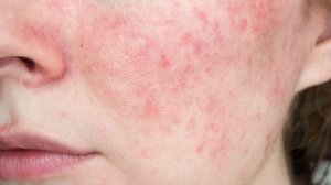 Reclaim Your Glow with Acne Treatment Today!