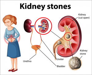 Kidney Stone Removal