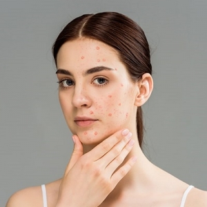Acne Treatment Clinic in Muscat