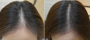 How to Incorporate Salicylic Acid Shampoo into Your Routine for Dandruff-Free Hair