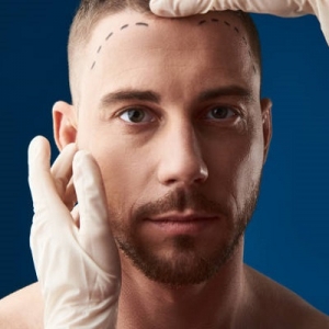FUT Hair Transplant