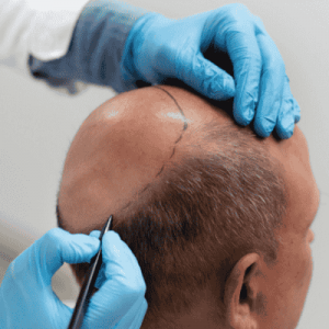 FUT Hair Transplant Clinic in Muscat