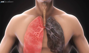 Global Chronic Obstructive Pulmonary Disease (COPD) Market Share, Size, Trends, Growth, Outlook & Forecast | 2023 - 2032