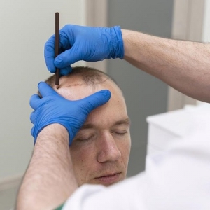 Best FUT Hair Transplant Clinic Muscat