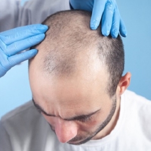 FUT Hair Transplant Clinic in Oman
