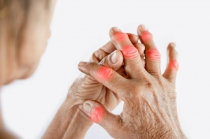 Psoriatic Arthritis Treatment: Understanding the Options Available to Manage this Chronic Inflammatory Condition