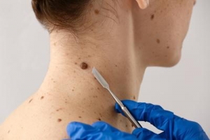 What Happens When You Get a Mole or Skin Tag Removed?