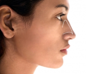 Nose Job & Rhinoplasty: Procedure, Benefits, Risks,