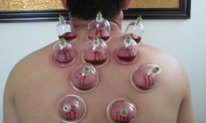 What to Expect: Hijama Treatment Costs in Dubai Explained