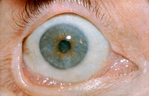 Neurotrophic Keratitis Market Size, Industry Trends, Share, Growth and Report 2024-2034