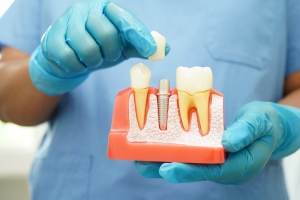 Fall Back in Love with Your Smile: Dental Crowns in Arlington for a New You