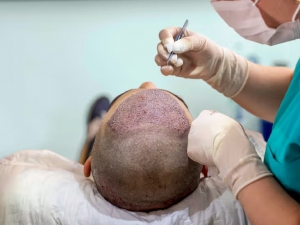 Guide to FUE Hair Transplant: Benefits, Process & Recovery