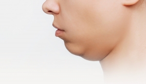 Double Chin Liposuction: Your Path to Confidence!