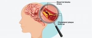 Ischemic Stroke Market Outlook, Industry Size, Growth Factors, Investment Opportunity 2024-2034