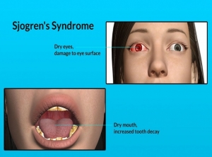 Sjogren's Syndrome Market Overview, Size, Share, Trends, Outlook, and Research Report 2024-2034