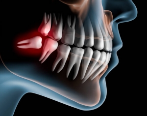 Understanding the Average Cost of Wisdom Tooth Removal: What to Expect