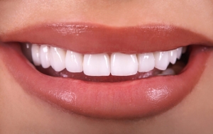 Dental Veneers and Their Types: Which Are the Best?