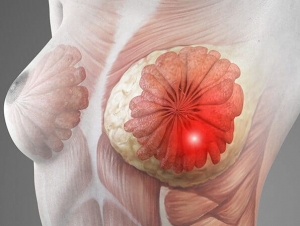 Proactive Health: Why Breast Cancer Screening is a Lifesaving Choice