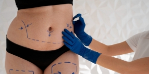 What Makes Vaser 4D Liposuction Stand Out?