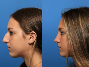 Understanding Rhinoplasty: Selecting the Best Surgeon for Your Requirements