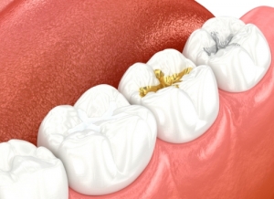 Dental Fillings for a Brighter Smile: How They Work and Why You Might Need One