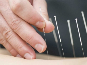 How Many time  Sessions Does It Take For Acupuncture To Work?