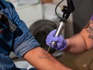 Why Choose Laser Tattoo Removal? Discover Now!
