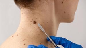 Mole Removal for Aesthetic and Health Reasons: What You Need to Know