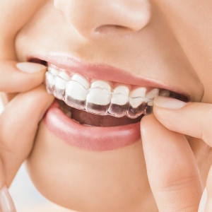 Transform Your Smile with Clear Aligners Evansville and Santa Claus