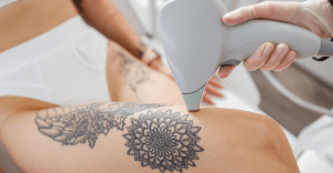 Tattoo Removal Methods: Which Option is Right for You