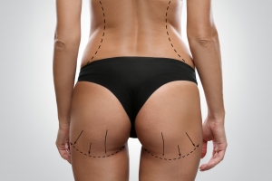 How Brazilian Butt Lift Can Transform Your Look!