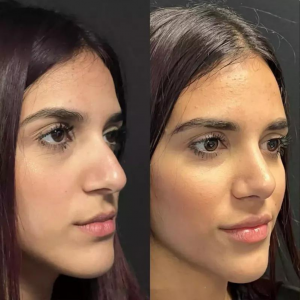 Your Guide to the Best Rhinoplasty Surgeon in Dubai for a Perfect Nose