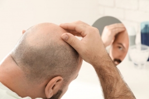 What Makes Hair Transplant a Top Choice?