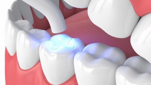 Can I Fill a Cavity at Home?