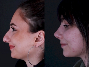 Revision Rhinoplasty in Turkey with Dr. Hasan Duygulu