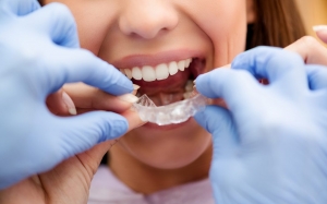Invisible Allies: The Benefits of Clear Retainers for Adults
