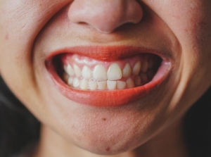 Revitalize Your Smile: The Growing Popularity of Gum Contouring in Dubai