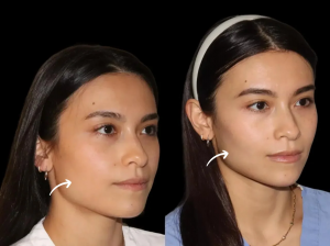 Choosing Sculptra: Best Aesthetic Clinic in Dubai's Expertise