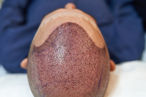 How Successful is a Hair Transplant?