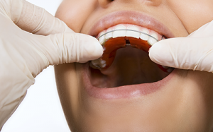 The Role of Retainers in Orthodontic Success: Insights from Dubai’s Top Dentists