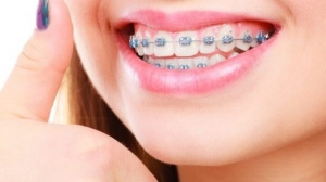 From Kids to Adults: Embracing Dental Braces for Every Age in Dubai