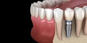 What to Expect: The Dental Implant Procedure in New Jersey Explained Step-by-Step