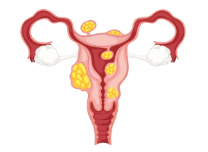 Ovarian Cyst: Symptoms, Types, Removal and Side Effects