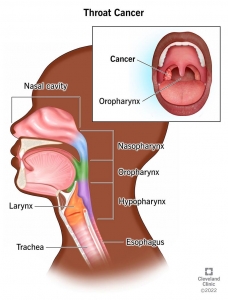 Laryngeal Cancer Market 2024: Latest Trends, Share, Industry Size, Growth Analysis, & Forecast Report by 2034