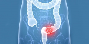 Colorectal Cancer Therapeutics Market is estimated to Witness High Growth Owing to Advancements in Targeted Therapy